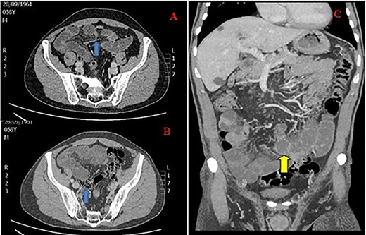 CT of the abdomen in a 59-year-old male with SBO; (A) transition point in the right iliac fossa (arrow), (B) feces sign (arrow) and (C) close loop obstruction (arrow).