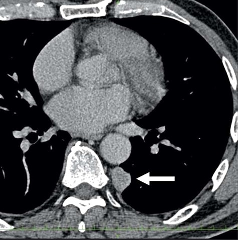 The computed tomographic findings of the primary tumor (arrow).