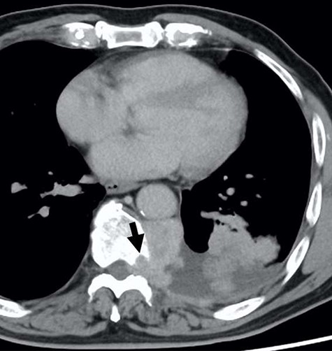 The computed tomographic findings of the current tumor; note the tumor extended through the neural foramen, and had an osteoclastic progression into the thoracic spine (arrow).