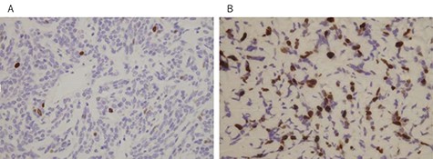 MIB-1 proliferation index (Ki-67) of the primary tumor (A) and the current tumor (B); (immunostain, original magnification X100).