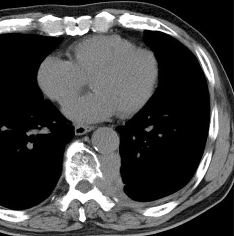 The computed tomographic findings after 6 weeks after radiotherapy.