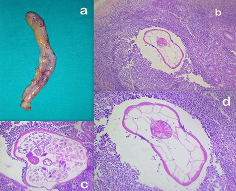 (a) Appendectomy specimen. (b–d) Microscopic appearance of AO at ×10 (b), ×20 (c) and ×40 (d) magnifications, respectively, showing mild congestion and luminal parasite.