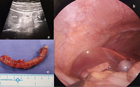 (a) SHA diagnosed and located on abdominal ultrasound. (b) Laparoscopic visualization of SHA. (c) Appendectomy specimen of theSHA.