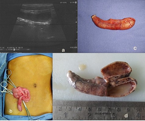 (a) AM as seen on abdominal ultrasound. (b) On table findings of AM at open appendectomy. (c) AM appendectomy specimen. (d) Gross pathology showing appendiceal lumen showing purulent material, thinned out wall and no obvious mass lesion.