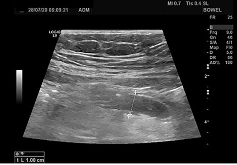 Abdominal ultrasound: The appendix is enlarged (diameter 1 cm) and non-compressible. Inflammation of the adjacent fat is also observed.