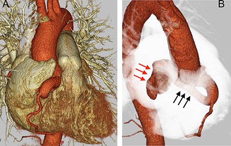 Preoperative CT findings; (A) frontal view; (B) upper right diagonal view; preoperation CT showed a dilated RCA (black arrow) with a diameter of 13.2 mm, and a giant aneurysm (red arrow) with an RCA-to-right atrium fistula.