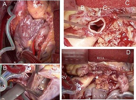 Intraoperative findings; (A) the RCA dilated from its origin; the coronary artery fistula is not visible because it is hidden by the right atrium; (B) the opening of the coronary artery fistula draining into the posterior wall of the right atrium, closed with 5-0 polypropylene continuous suture (*); (C) dissected origin of the dilated RCA; (D) dilated RCA closed with 4-0 polypropylene mattress with over and over suture to preserve the morphology of the sinus of Valsalva (★).