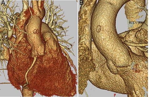 Postoperative CT findings; (A) RITA-RCA bypass; (B) the sinus of Valsalva is shown with preserved morphology; RITA, right internal thoracic artery.