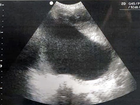 Transvaginal ultrasound showing a heterogeneous mass in the uterinewall.