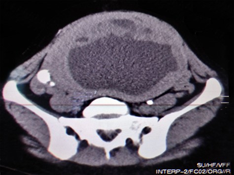 CT scan showing irregular mass with central necrosis.