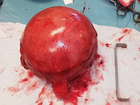 It shows the mass after surgical excision.