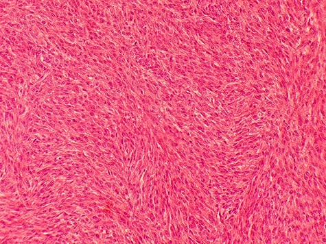 Microscopic picture shows atypical leiomyoma consistent with cellular leiomyoma with rate of mitosis <5 perHPF.