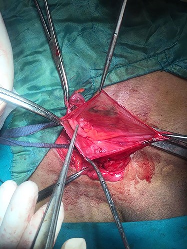 Sliding Amyand’s hernia.