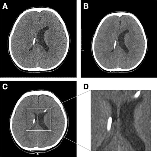 Fifteen years after VP shunt brain CT shows slit-like ventricle. In particular, the right ventricle collapsed where the proximal catheter was located (A). After a shunt pressure upgrade with mannitol administration, the patient’s symptoms worsened, and brain CT showed a collapsed ventricle (B). Three days after EVD insertion, the right ventricle was enlarged (C). Magnified image of enlarged ventricle (D).