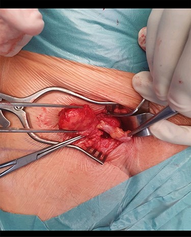 The hernial sac and the tip of the appendix held with forceps and its body densely adherent to the sac.