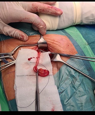 The long vermiform appendix after being completely mobilized.