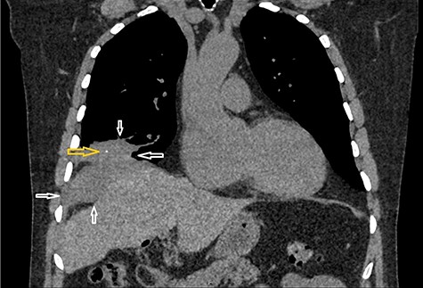 CT scan chest coronal view: Figure demonstrates a mass lesion at the right lung base with an area of calcification. White arrows demonstrate the edges of the mass lesion. Yellow arrow denotes the area of calcification in the mass.