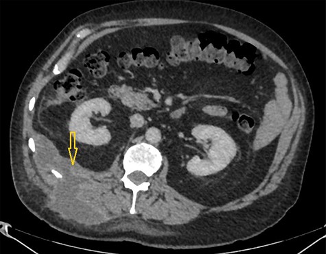 CT scan abdomen demonstrates a retroperitoneal abscess tracking through an intramuscular opening onto skin in the right paraspinal region.