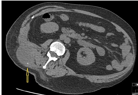 Non-contrast CT abdomen: CT scan demonstrates a small hyper dense calculus in the abscess marked by an arrow. Here patient is lying in slightly left lateral position due to pain caused by the abscess.