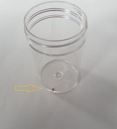 Image shows a small calculus removed during incision and drainage of the back abscess.