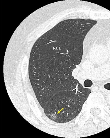 An image from CT scan taken in the axial plane. The tumor is located in the S6 of the right lung (arrow). RUL, right upper lobe; S6, superior segment.