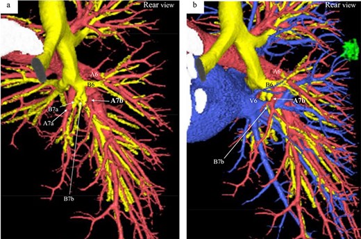 Three-dimensional CT angiography and bronchography images. (a) Rear-view CT angiography image of the PA and bronchi. (b) Rear-view CT image of the PA, PV, and bronchi. Reconstructed images of the pulmonary arteries (red), pulmonary veins (blue), bronchi (yellow) and tumor (green). A, pulmonary artery; B, bronchus; V, pulmonaryvein.