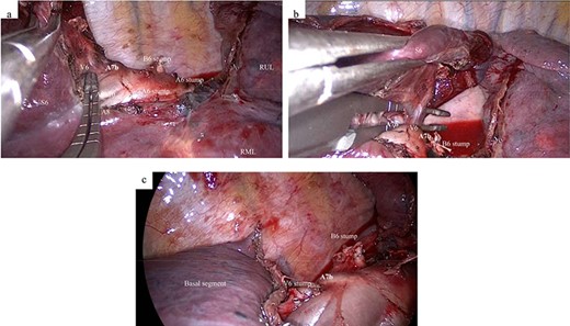 Intraoperative findings. (a) After division of the B6 and A6, an aberrant A7b is detected on the cranial side of the V6. (b) After inserting the dissecting forceps between the V6 and the aberrant A7b, the A7b is detected behind the V6. (c) After dissection of the V6 and lung parenchyma between the S6 and basal segment. A6, superior segmental pulmonary artery; A7, medial basal segmental pulmonary artery; B6, superior segmental bronchus; RML, right middle lobe; RUL, right upper lobe; S6, superior segment; V6, superior segmental pulmonaryvein.