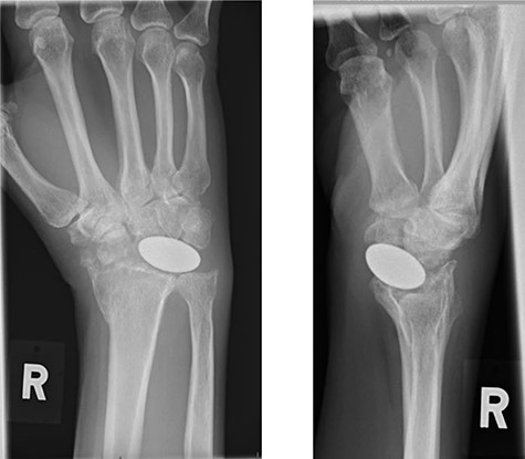 X-rays of the right hand 2-months post-operative.