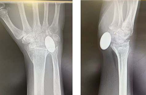 X-rays of the right hand showed palmar displacement of the pyrocarbon implant.