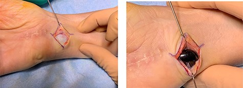 Intra-operative clinical photographs of the migrated pyrocarbon implant.