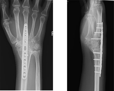 Post-operative radiographs following removal of pyrocarbon implant and total wrist fusion.