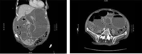 CT abdomen and pelvis on presentation; swirling of the SMA, markedly distended stomach and small intestine are noted.