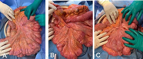 (A) Upon evisceration of the small bowel, abnormally elongated mesentary was noted; (B) small bowel mesentery pexy to the mesocolon is performed medial to lateral; (C) upon completion of the pexy, the small bowel mesentery is shortened and thickened.