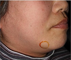 Extraoral findings; a 15-mm indurated mass is seen at the right mandibular margin.