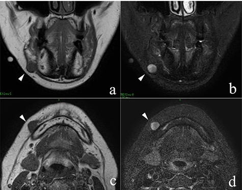 MRI findings; the arrowheads indicate the schwannoma; (a) low signal intensity on T1-weighted coronal image; (b) high signal intensity on T2-weighted coronal image; (c) low signal intensity on T1-weighted axial image; (d) high signal intensity on T2-weighted axial image.