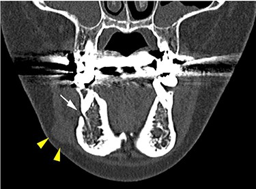 CT findings of a coronal section; yellow arrowheads indicate the schwannoma; the white arrow indicates the mental foramen.