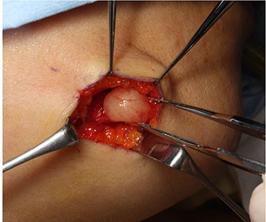 Intraoperative findings of tumor enucleation; the marginal mandibular branch of the facial nerve, which was thought to be the nerve of origin, was seen proximal to the tumor.