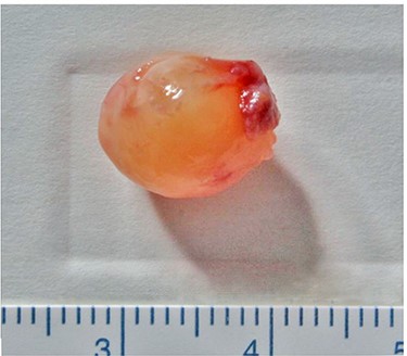 Excised mass; it is a yellowish-white, spherical, encapsulated, solid mass.