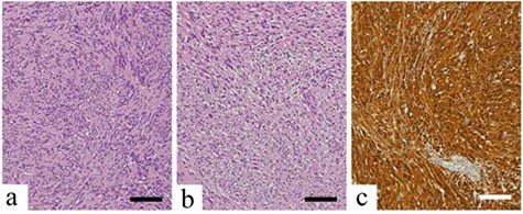 Histopathological findings; scale bars indicate 100 μm (a) Antoni Type A tissue with regular arrangement of tumor cells with spindle-shaped and elongated nuclei; (b) Antoni Type B tissue with spindle-shaped cells in an edematous and myxomatous background; (c) the neoplastic cells are strongly stained with S-100 protein.