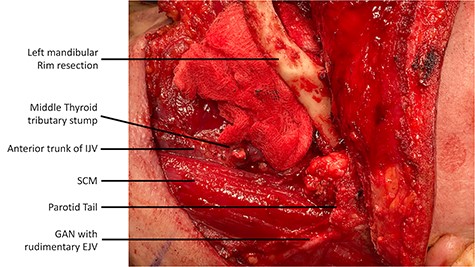 Lateral view of the left neck dissection demonstrating the anterior trunk of the duplicated IJV located antero-medially to the SCM muscle; the dissection of the greater auricular nerve and the presence of a rudimentary EJV is also known.