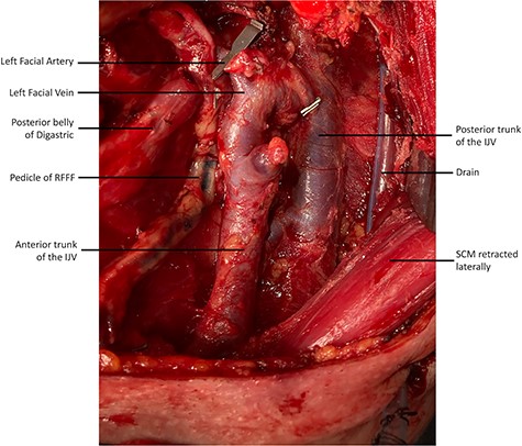 The duplicated IJV is demonstrated post-neck dissection and after the flap inset (recipient facial artery and pedicle of RFFF is shown).