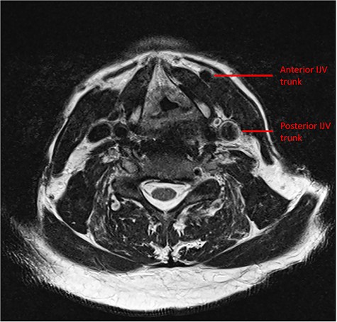 Preoperative MRI demonstrating the duplicate trunks of the left IJV.