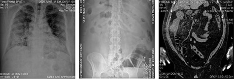Imaging studies; (A) patient’s chest X-ray with bilobular diffuse pulmonary and alveolar infiltrate along with multiple opacities are present; (B) patient’s abdominal X-ray with dilated small intestine and colon with an occlusion located at the hepatic angle; edema and abdominal air fluid levels are noted; (C) abdominal CT scan showing engrossment of the ascending colonic wall at the hepatic angle with inflammation of pericolic adipose tissue; no free air or liquids are appreciated, suggesting a colonic occlusion.