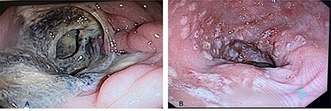Colonoscopy views of the patient’s colon; (A) ascending colon with circumferential lesions and mucous membrane surrounded by necrotic and fibrotic tissue; (B) sigmoid colon and rectum with multiple ulcerated lesions observed, with depositions of fibrin from 5 to 10 mm in diameter, which represents the classic ‘flask-shaped lesions’ characteristic of amoebic colitis.