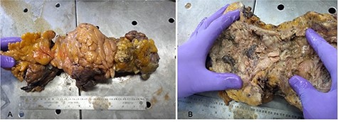 Macroscopic images of patient’s ascending colon; (A) ascending colon surrounded by epiploic appendages and inflamed adipose tissue; (B) ascending colon showing circumferential necrotic and fibrous tissue deposition.
