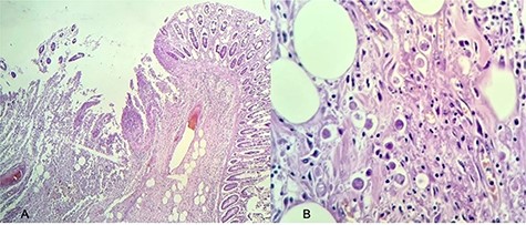 Histopathology of the patient’s resected colon; (A) intestinal crypts with multiple neutrophilic infiltrate (stained with hematoxylin and eosin, magnification 20×); (B) presence of multiple E. histolytica trophozoites (stained with hematoxylin and eosin, magnification 40×).