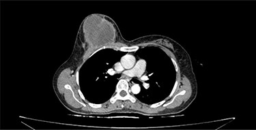 Phyllodes tumor on CT scan.