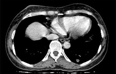 Lung metastasis on chest CT scan.