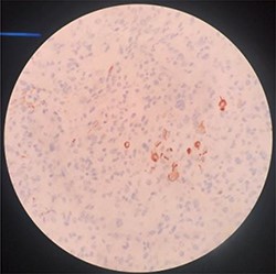 H-E sample of malignant phyllodes tumor with osseous and chondroid metaplasia.