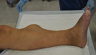 Indolent swelling of the left lower limb measuring 10 cm × 8 cm. Distal pulses were not palpable. Original magnification: 4024 × 2290 pixels.